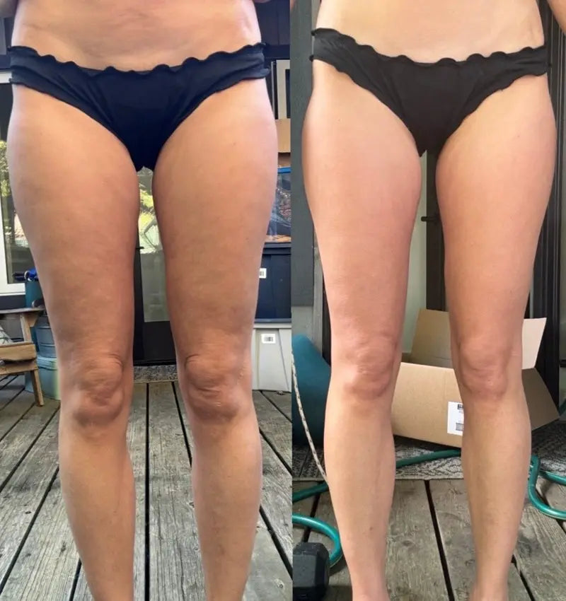 Antes y despues real de piernas tras tres semanas usando el masajeador anticelulitico Redulitis 2.0