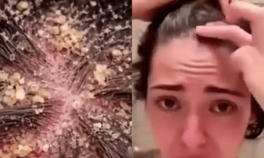 Caspa vista de cerca en el cuero cabelludo y la reaccion al separarse el pelo