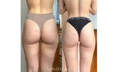 Resultado real de una clienta usando el masajeador Redulitis 2.0
