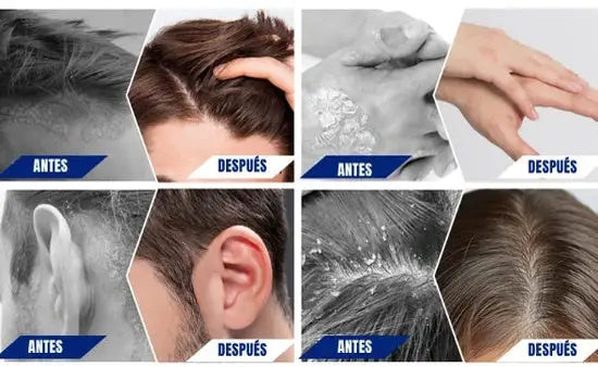 Antes y despues en cuero cabelludo, manos y piel con RoyceDerm