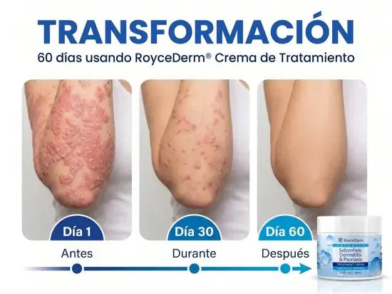 Transformacion en 60 dias usando RoyceDerm: dia 1, dia 30 y dia 60